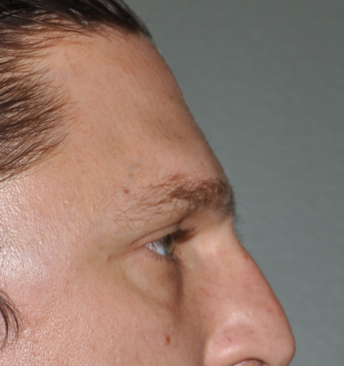 Brow Bone/Forehead Reduction Sugeon Dr. Barry Eppley
