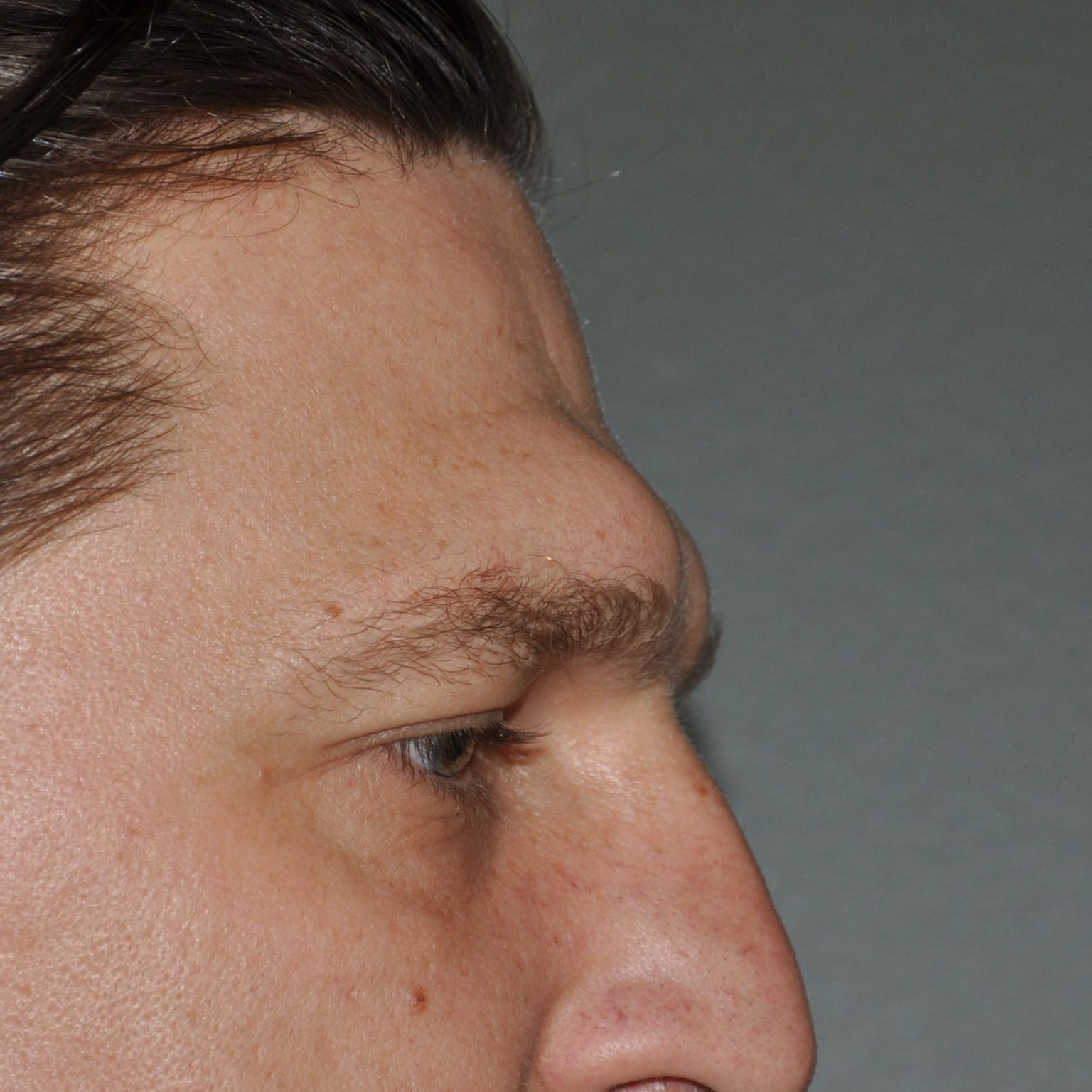 Brow Bone/Forehead Reduction Sugeon Dr. Barry Eppley