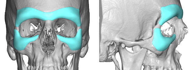 How Are Custom Brow Bone and Infraorbital Rim Implants Inserted ...