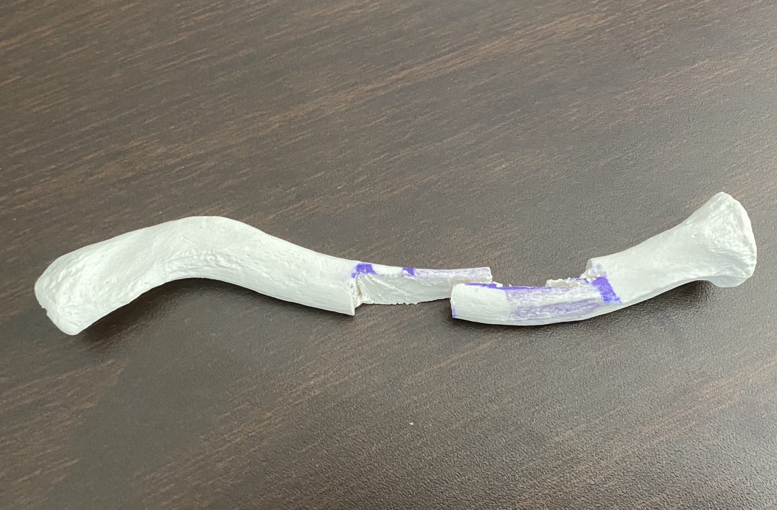 How Much Shoulder Widening (Clavicle Lengthening) Can Be Safely