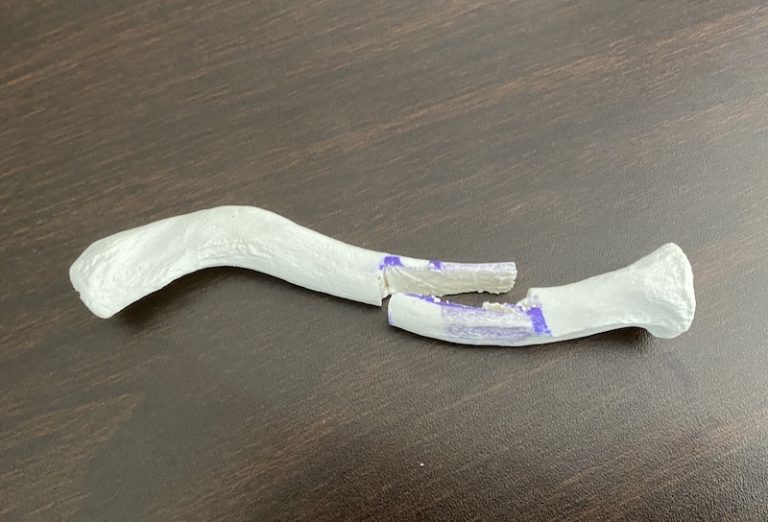 How Much Shoulder Widening (Clavicle Lengthening) Can Be Safely