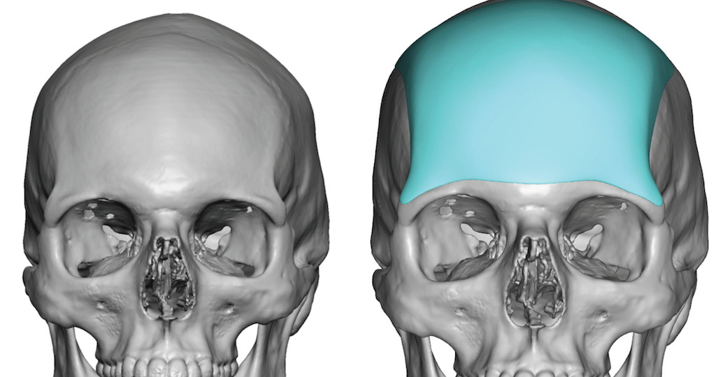 Can A Sloped Forehead be Fixed? Plastic Surgeon Dr. Barry L. Eppley, MD