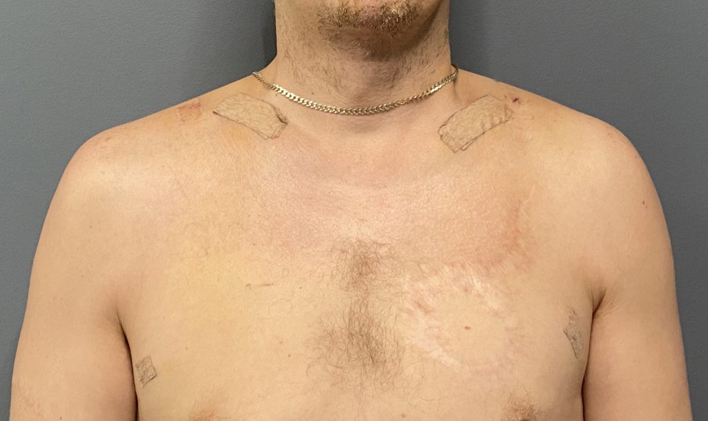 Shoulder Narrowing & Widening Surgery Plastic Surgeon Dr. Eppley