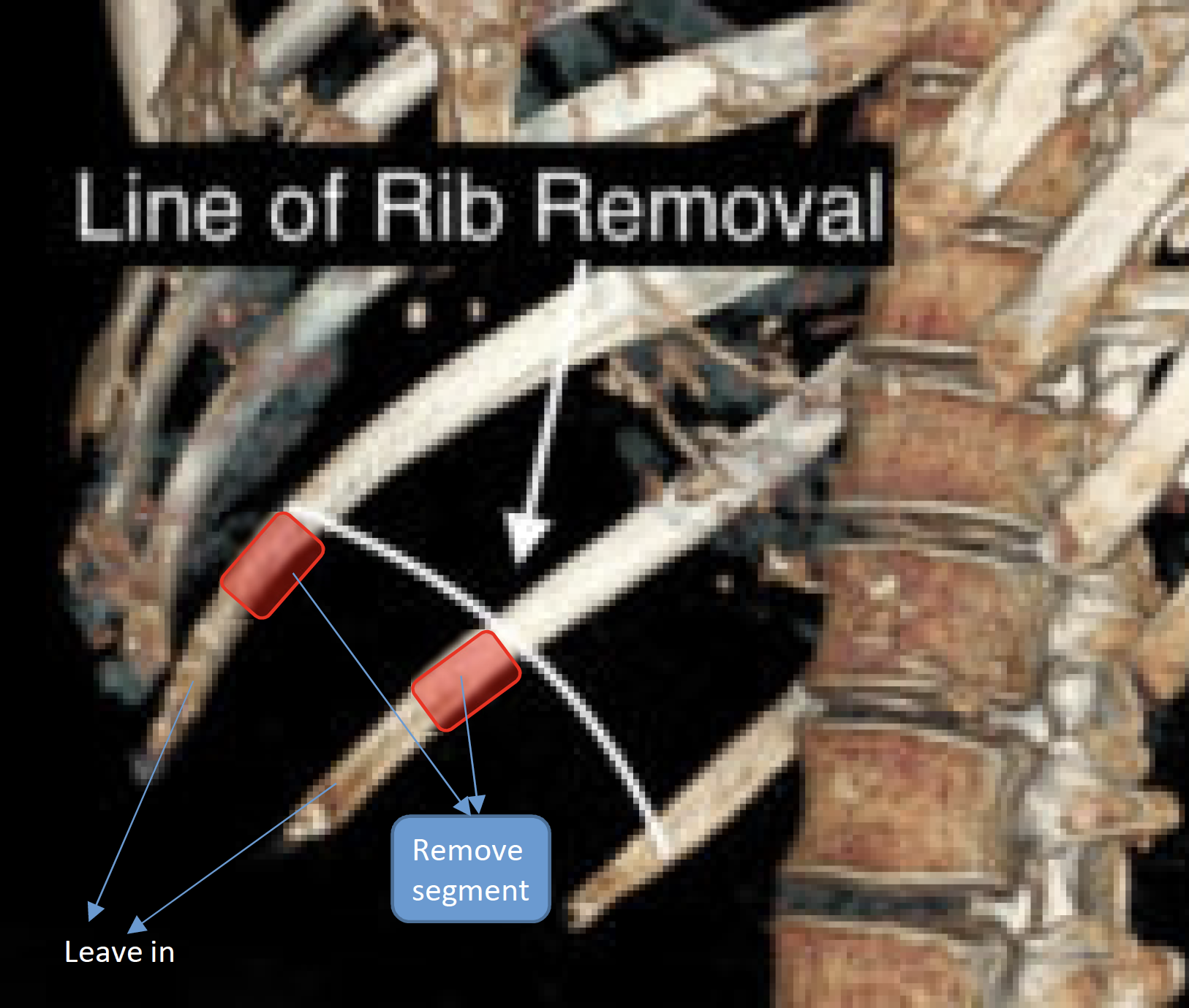 is Rib Ostectomy As Good As Rib Removal In Waistline Narrowing Surgery
