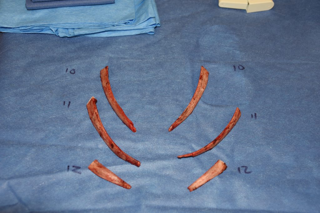 What Are The Differences Between Rib Removal vs Rib Fracture For