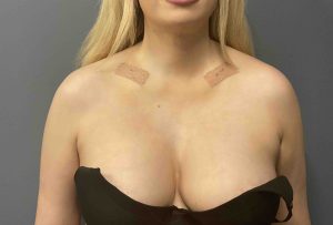 female broad shoulders before Dr Barry Eppley Indiana;polis - Explore  Plastic Surgery