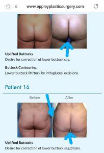 Will A Lower Buttock Lift Make My Buttocks Look Flat Or Square-Shaped? -  Plastic Surgeon