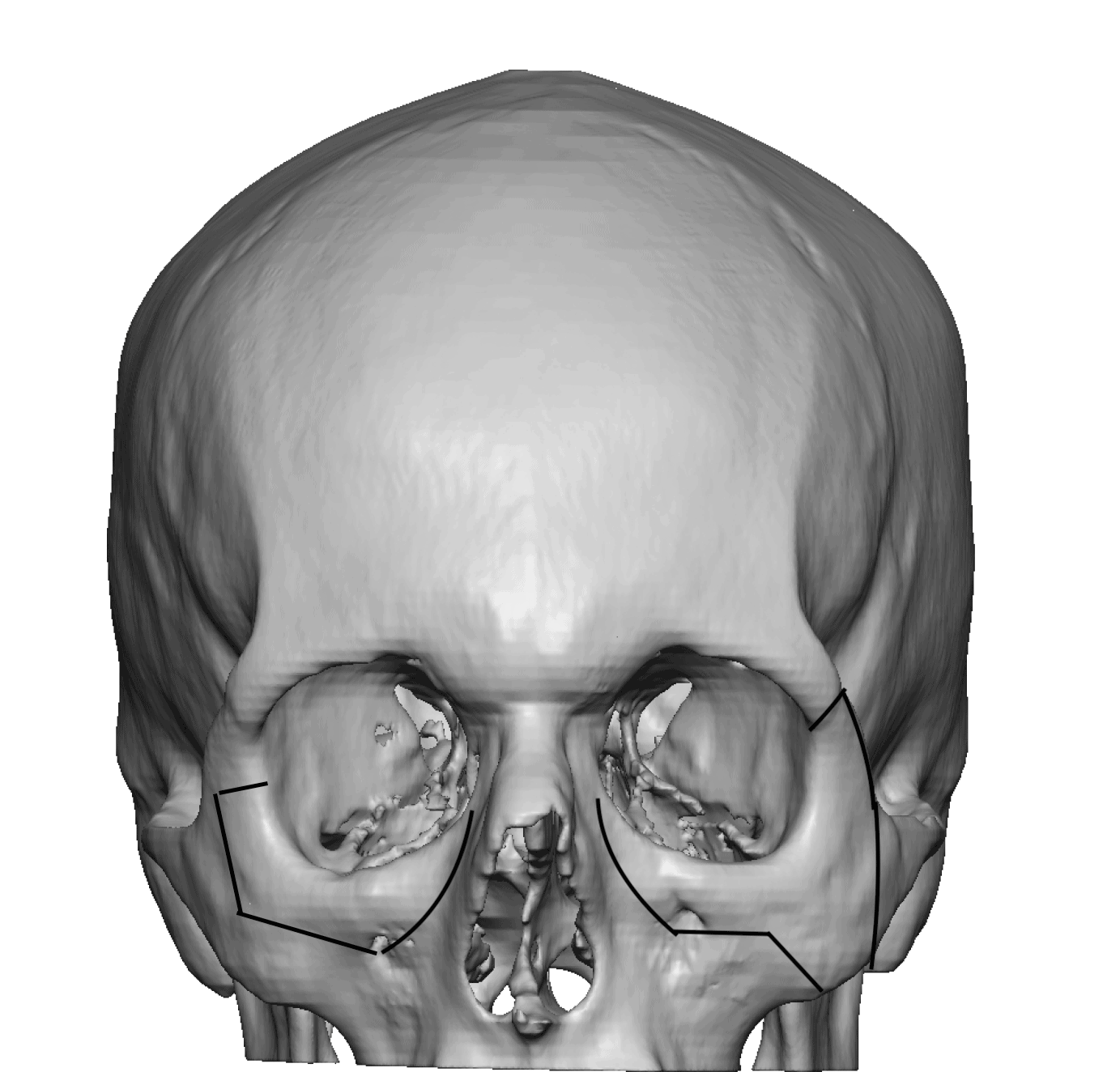 What Can Be Done To Widen The Interpupillary Distance In An Adult