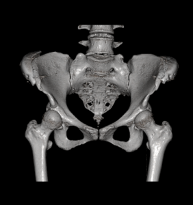 Will Iliac Crest implants Reduce The Vertical Distance Between The